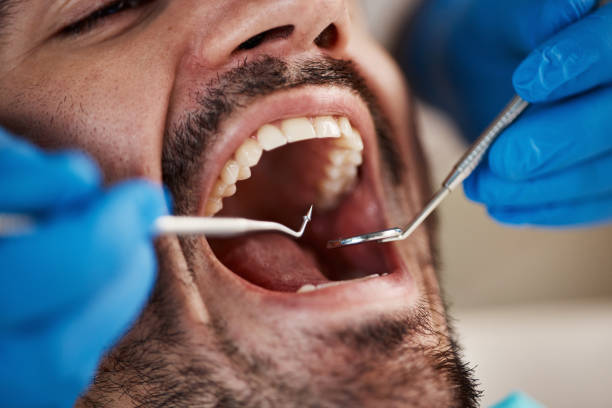 Best Emergency Dentist for Lost Fillings or Crowns in Fairbury, IL